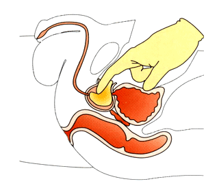 Cirugía para próstata