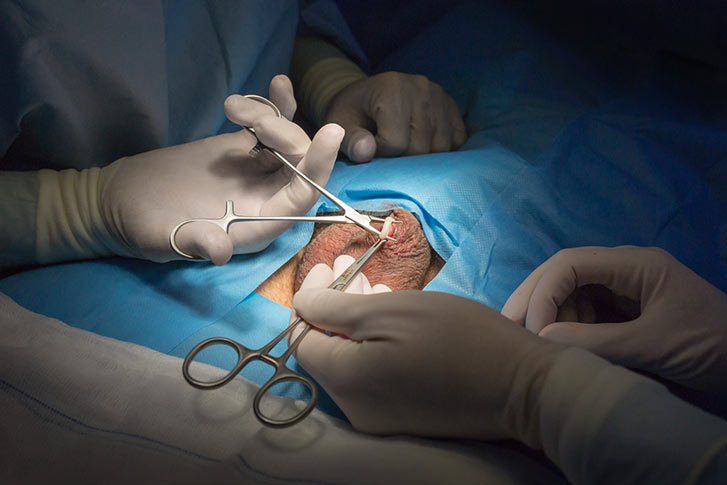 Fotos de una vasectomía