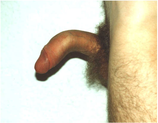 incurvación de pene