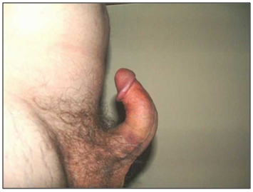 incurvacion-pene-casos