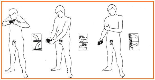 incurvacion-pene-diagnostico