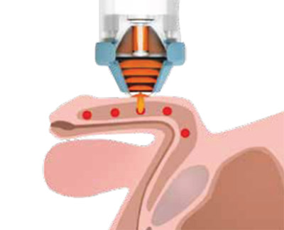 Aplicación de Ondas de Choque sobre tejido eréctil