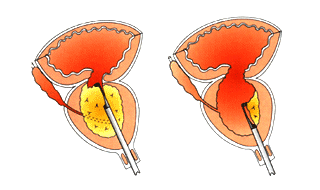 Tratamientos de próstata