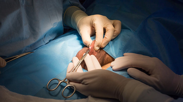 Vasectomía sin bisturí