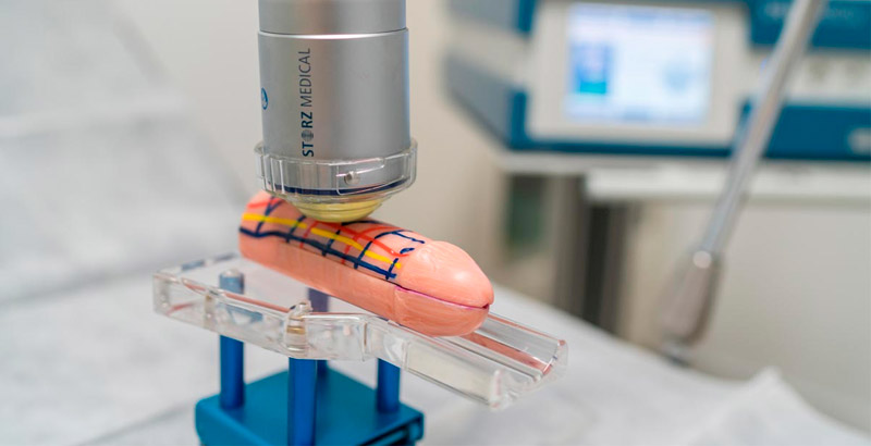 Las ondas de choque pueden mejorar la disfunción eréctil