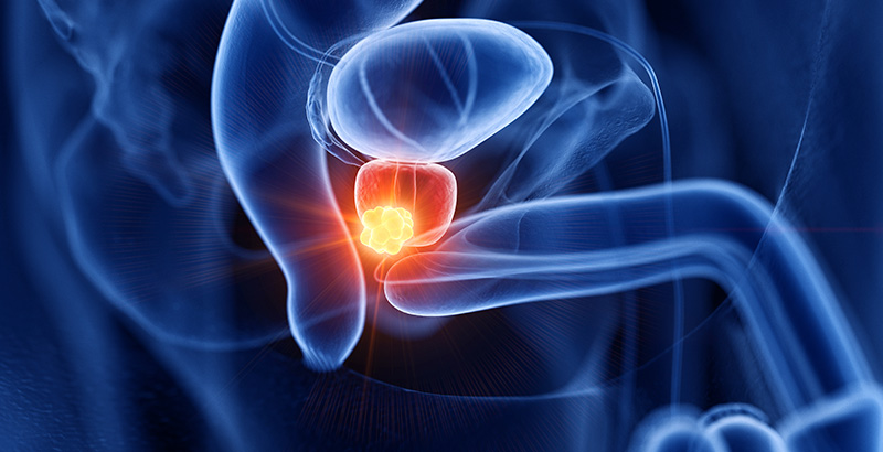 Simulación cáncer de próstata zaragoza