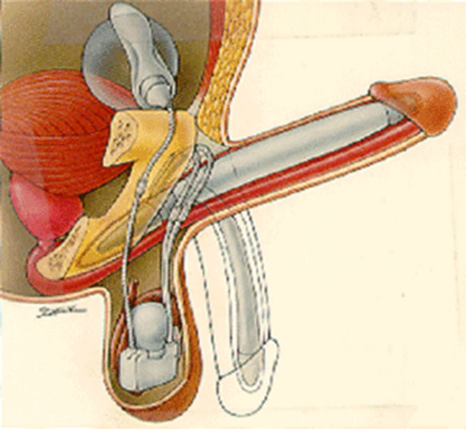 Colocación prótesis de pene