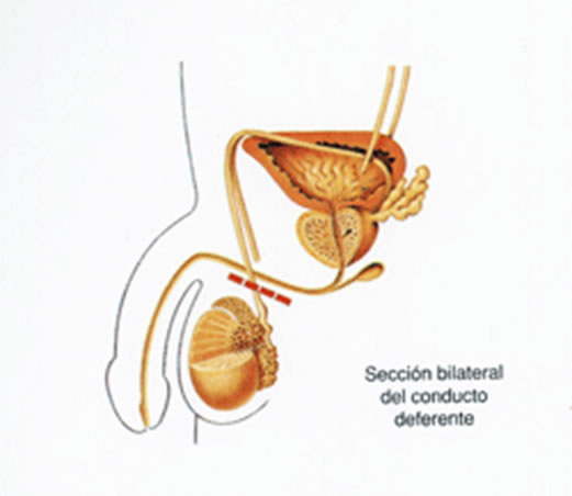 Vasectomía, Instituto Uroandrología